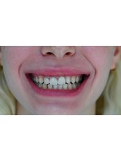 Dental Bridges - Dr. Ertuğrul Çetinkaya