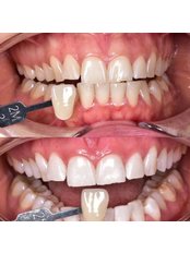 Teeth Whitening - Dr. Ertuğrul Çetinkaya