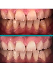 Teeth Whitening - Dr. Mete Toptaş
