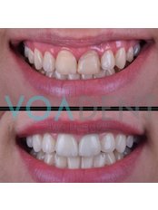 Dental Crowns - Voadent