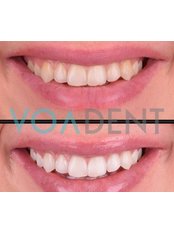 Teeth Whitening - Voadent