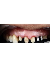 Dental Crowns - Beykent Dental Clinic
