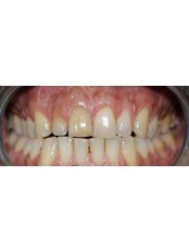 Teeth Whitening - Beykent Dental Clinic