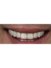 Zirconia Crown - Beykent Dental Clinic