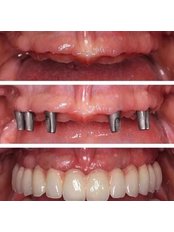 Dental Implants - Dent-i Delil Ağız ve Dİş Sağlığı Polikliniği