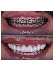 Orthodontics - Medispa Clinic Turkey