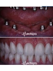 Dental Implants - Medispa Clinic Turkey