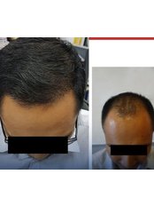 Hair Transplant - Medispa Clinic Turkey