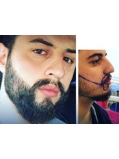 Beard Transplant - Medispa Clinic Turkey