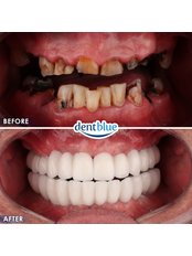 All-on-4 Dental Implants - DentBlue International Dental Clinic
