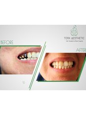 Dental Implants (per tooth) - Turk Aestehtic Dentistry