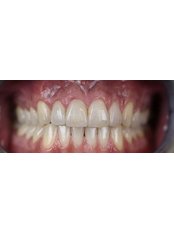 Teeth Whitening - Flora Diş Dental Clinic