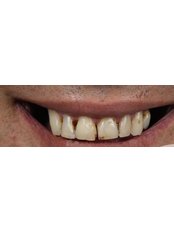 Zirconia Crown - Flora Diş Dental Clinic