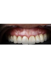 Dental Crowns - Flora Diş Dental Clinic