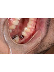 Single Implant - CAPA Cerrahi Estetik Dental Clinic