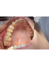 Restoration of Implants - CAPA Cerrahi Estetik Dental Clinic