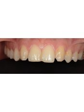 Porcelain Veneers - CAPA Cerrahi Estetik Dental Clinic