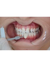 Zoom! Teeth Whitening - CAPA Cerrahi Estetik Dental Clinic