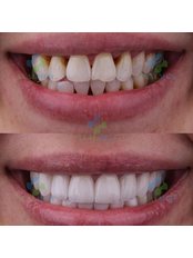 Dental Crowns - IXALMED