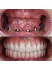 All-on-4 Dental Implants - IXALMED
