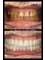 Dentafulya Dental Clinic - Zirconia crowns 