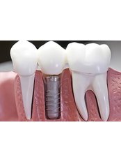 Dental Crowns - Dentakademi Oral & Dental Healthcare Centre