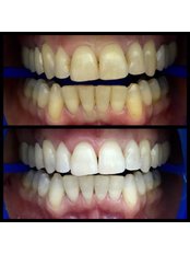 Teeth Whitening - Dentakademi Oral & Dental Healthcare Centre