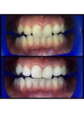 Teeth Whitening - Dentakademi Oral & Dental Healthcare Centre