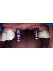 Dental Implants - Dentakademi Oral & Dental Healthcare Centre