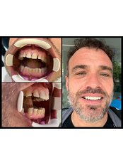 Zirconia Crown - Dentakademi Oral & Dental Healthcare Centre