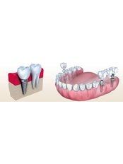 Dental Bridges - Dentakademi Oral & Dental Healthcare Centre