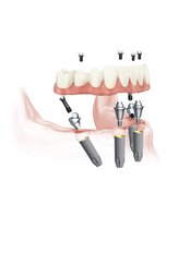 All-on-4 Dental Implants - Dentakademi Oral & Dental Healthcare Centre