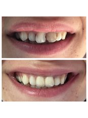Porcelain Crown - Dentakademi Oral & Dental Healthcare Centre