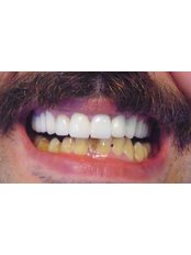 Zirconia Crown - Dentaloji  Dental  Clinic