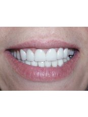 Porcelain Crown - Dentaloji  Dental  Clinic