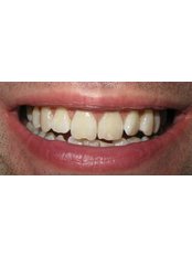 Teeth Whitening - Dr. Can Yenigun- Periodontology Specialist