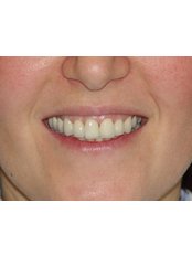 Dental Crowns - Dr.Cem Baysal - Implantology/Radiology Specialist