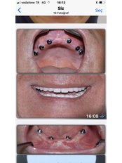 Single Implant - Dr.Dt Tolga Gülçiçek  / Advance Implantology  & Esthetic Dentistry  / Oral and Maxillofacial Surgeon