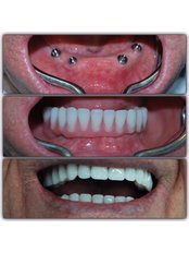 Dental Implants - Dr.Dt Tolga Gülçiçek  / Advance Implantology  & Esthetic Dentistry  / Oral and Maxillofacial Surgeon