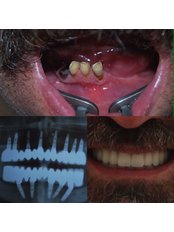 Immediate Implant Placement - Dr.Dt Tolga Gülçiçek  / Advance Implantology  & Esthetic Dentistry  / Oral and Maxillofacial Surgeon