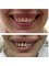 Dr. Didehan's Smile - Gummy Smile Reduction (Upper Lip lift and Gingivectomy) 