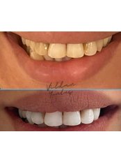 Teeth Whitening - Vildan Yontuç