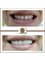 Golden Smile Ağız ve Diş Sağlığı Polikliniği - Crowns Turkey 