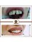 Golden Smile Ağız ve Diş Sağlığı Polikliniği - Zirconium Crowns 