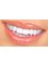 Golden Smile Ağız ve Diş Sağlığı Polikliniği - Veneers in Turkey 
