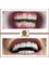 Golden Smile Ağız ve Diş Sağlığı Polikliniği - Dental crowns in Turkey 
