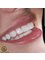 Golden Smile Ağız ve Diş Sağlığı Polikliniği - Zirconium Crowns 
