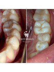 Fillings - Dent Dream Dental Clinic