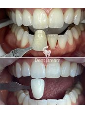 Teeth Whitening - Dent Dream Dental Clinic