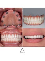 All-on-6 Dental Implants - DENTSUADIYE